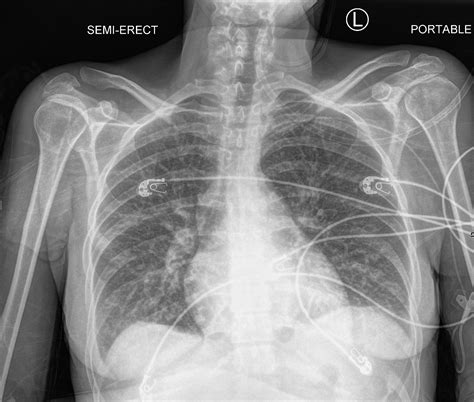 Chest X Ray And Heart Failure CXR And CHF Heart
