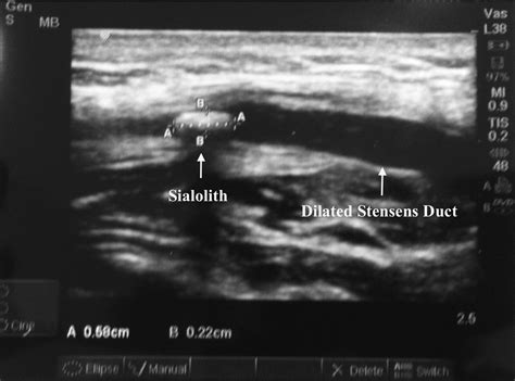 Bedside Emergency Ultrasound In A Case Of Acute Parotid Duct