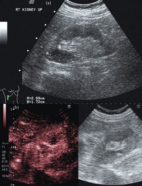 Prominent Renal Pyramid A Grey Scale Ultrasound Demonstrated A