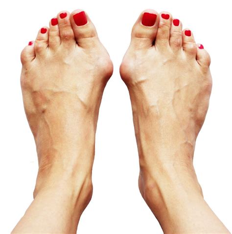 Woman S Feet With Bunions Woman Foot Bunion Finn Comfort