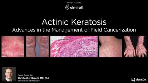 Actinic Keratosis Advances In The Management Of Field Cancerization
