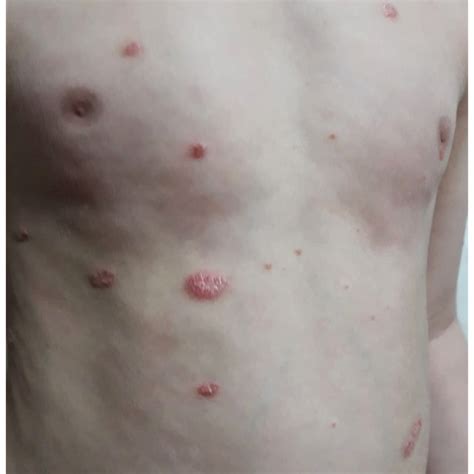 Pdf Management Of Psoriasis In Children Review