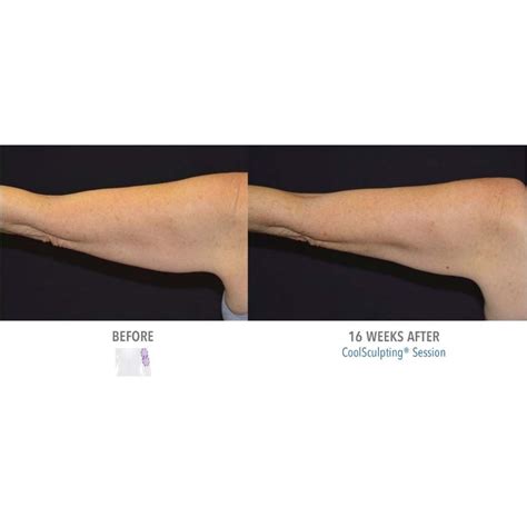Reduce Arm Fat And Tighten Skin With Coolsculpting Alpharetta Ga