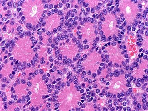 Acinar Cell Carcinoma Of The Pancreas And Related Neoplasms A Review