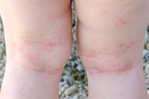 Atopic Eczema Common Symptoms Children Age Atopic Dermatitis Symptoms
