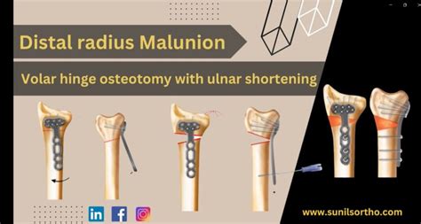 Volar Osteotomy For Distal Radius Malunion —