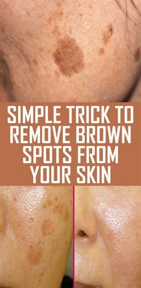 Simple Trick To Remove Brown Spots From Your Skin Brown Spots On Skin