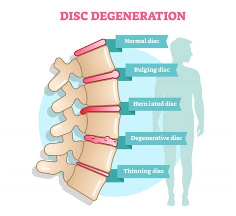 Bulging Discs Vs Herniated Discs Advanced Chiropractic Spine