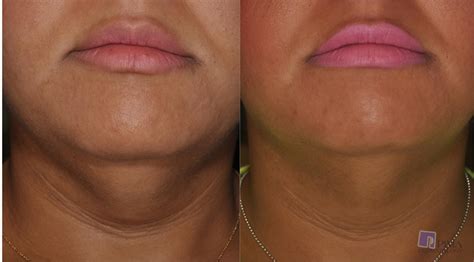 Submental Fullness Double Chin Treatment By Tucson Experts