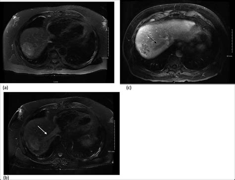 Mri At Initial Presentation A Axial T2 Fat Saturated Image