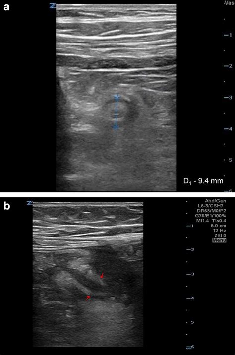 Point Of Care Ultrasound Diagnosis Of Stump Appendicitis In The