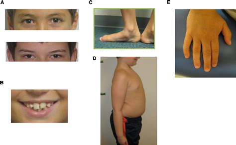 47 Xyy Syndrome Clinical Phenotype And Timing Of Ascertainment The Journal Of Pediatrics