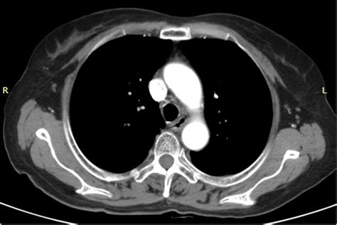 Chest Ct Scan Showing Tracheal Patency After Tracheal Stent Removal