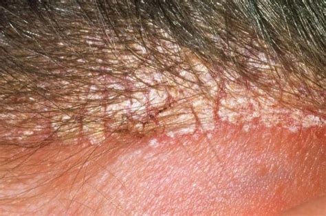 White Scaly Patches On Skin Can It Be A Sign Of Seborrheic Dermatitis