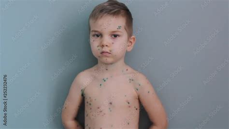 Sad Boy With Chickenpox Sick Child Chicken Pox Portrait Of Young Boy