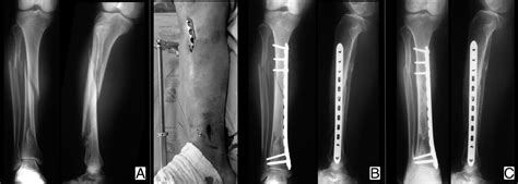 Management Of Diaphyseal Tibial Fractures By Plate Fixation With