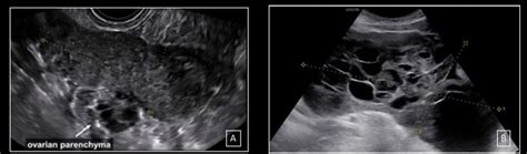 Ovarian cancer screening is not actually recommended for people at an average risk of developing the condition. Ultrasound, macroscopic and histological features of ...
