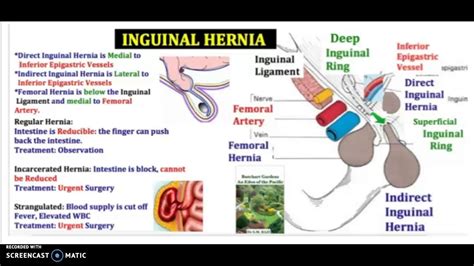 Direct Vs Indirect Hernia Mbbs Medicine Humanity First Difference