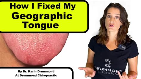 Geographic Tongue Remedy For Geographic Tongue