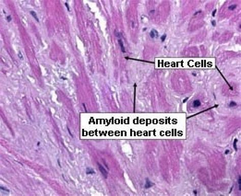 Change In Protocol Heart Transplants For Amyloidosis Patients