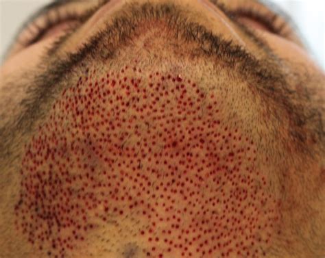 C) use the present perfect tense or the present perfect continuous to fill in the blanks: Does minoxidil work beard - BeardStylesHQ