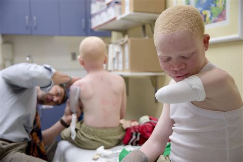 Global Journalist Africans With Albinism Face Discrimination Attacks