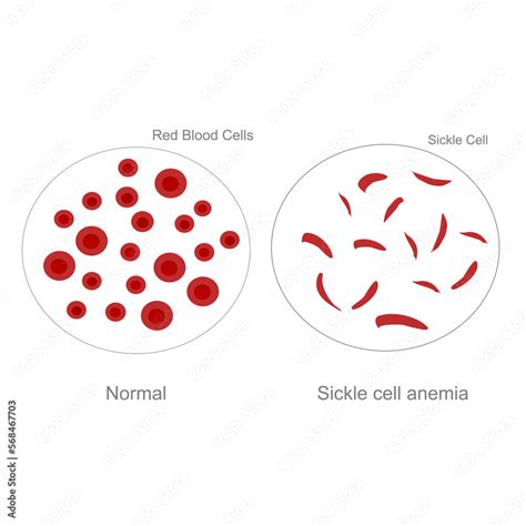 The Difference Morphology Of Red Blood Cells Between Normal Cells And
