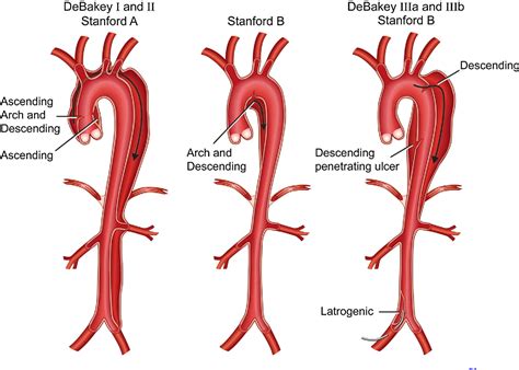 Figure 1 From Computational Biomechanics In Thoracic Aortic Dissection