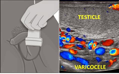 Maybe you would like to learn more about one of these? Obat Varikokel Alami Sembuh Total Tanpa Operasi | Klinik ...