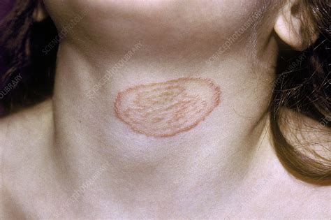 Ringworm Fungal Infection Stock Image C052 2023 Science Photo Library