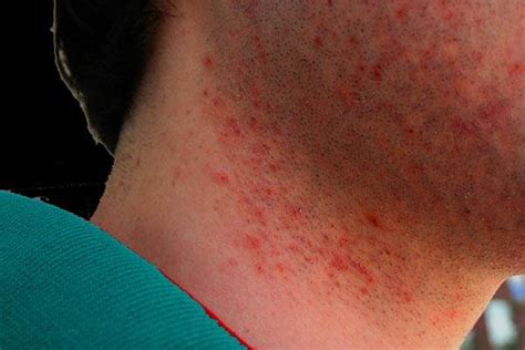 Shea butter is a great source of vitamins a and e as well as keratin. Natural Remedies Helps You to Get Rid of Eczema Scars ...