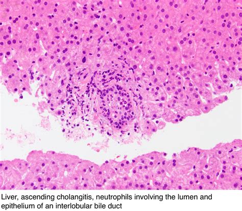 Pathology Outlines Ascending Cholangitis