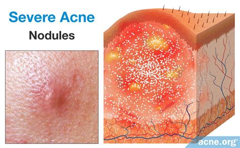 What Is Acne An In Depth Look