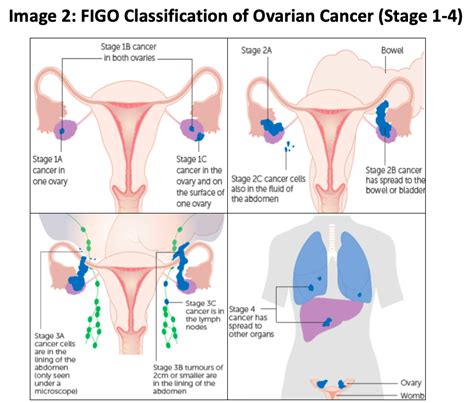 Ovarian Cancer Classification Hot Sex Picture
