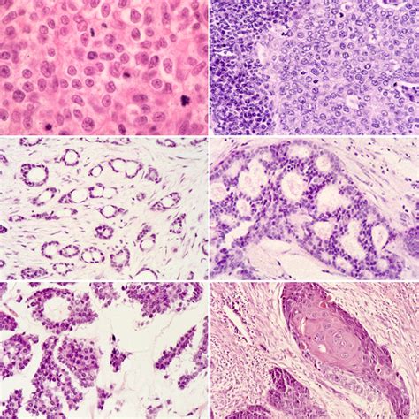 Breast Ductal Carcinoma