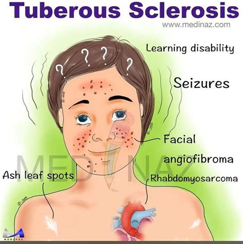 Tuberous Sclerosis Mnemonic Medizzy