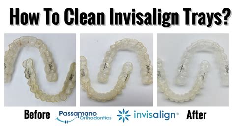 Regularly cleaning your retainer is a necessity for good health. How to Clean a Crusty Invisalign Tray or Retainer at Home