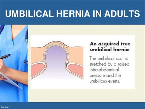 Abdominal Umbilical Hernia