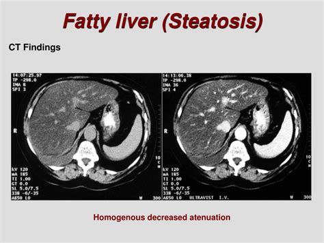 Ppt Diffuse Liver Disease Powerpoint Presentation Free Download Id