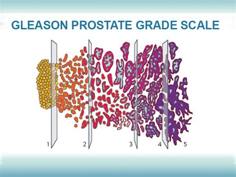 Prostate Cancer What You Need To Know About The Gleason Score