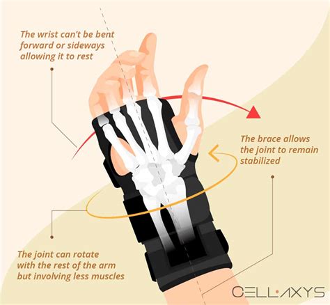 How To Manage Ulnar Sided Wrist Pain With A Brace Cellaxys Atelier
