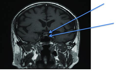 brain mri pituitary tumor
