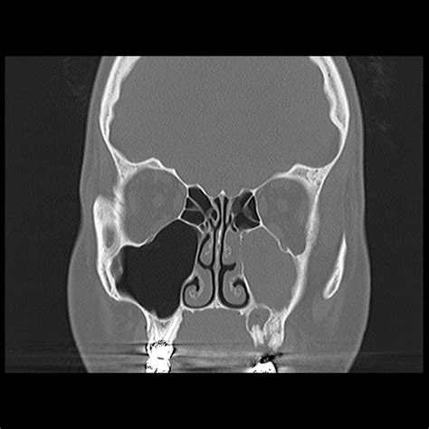 I have found the following websites quite useful for learning. How To Read A Sinus Ct Scan