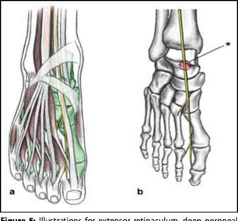 Pdf Anterior Tarsal Tunnel Syndrome Secondary To Missed Talus