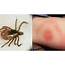 What Is Lyme Disease And Are The Symptoms Of Rapidly 