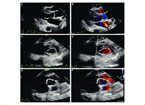 Transthoracic Echocardiogram Demonstrating Right Ventricular Outflow