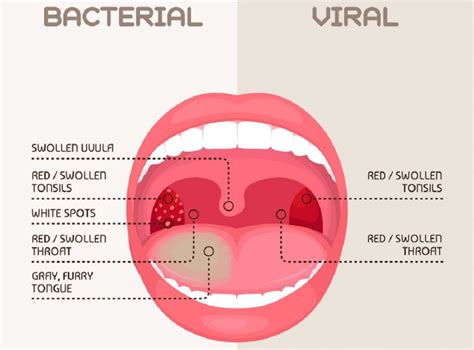 strep throat symptoms causes natural treatments strep throat symptoms strep throat strep