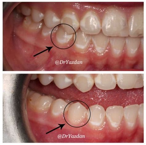 White Spots On Gums From Smoking