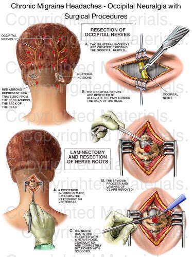 Chronic Migraine Headaches Occipital Neuralgia With Surgical