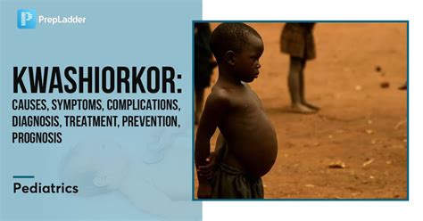 Kwashiorkor Causes Symptoms Complications Diagnosis Treatment
